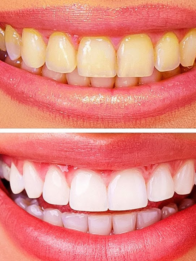 10 Ways to Whiten your Teeth easily